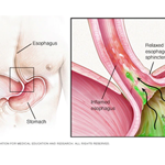 Acid Reflux Treatment (GERD)