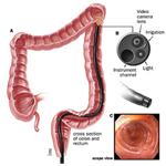 Flexible Sigmoidoscopy